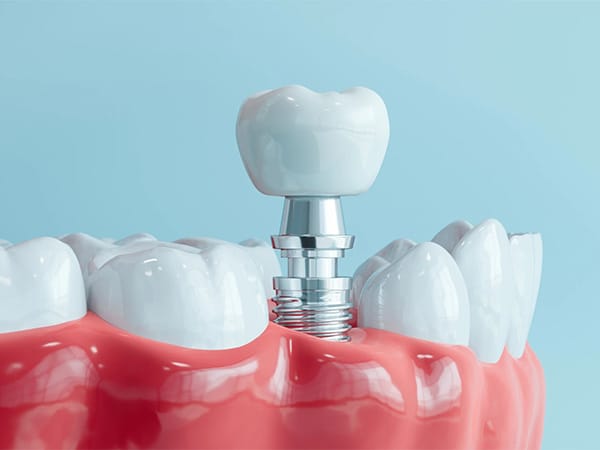 implantes-dentales-en-rd